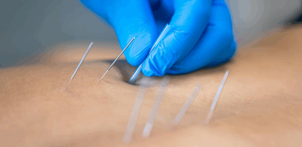 Dry needling treatment with fine acupuncture needles applied to relieve muscle tension and pain